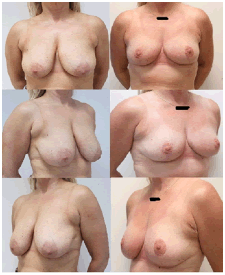 ijocs-mammoplasty